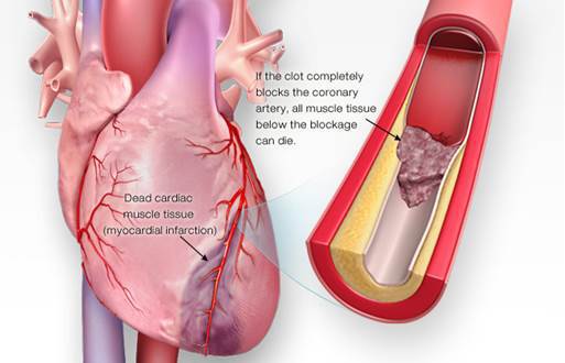 Diagram of an atherosclerosis-caused heart attack.