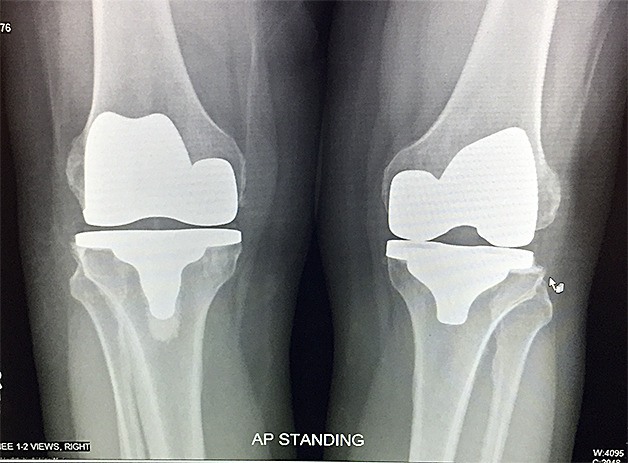 An X-ray image showing Ralph Dreitzler’s two knee replacements. His ConforMIS implant can be seen at left; at right