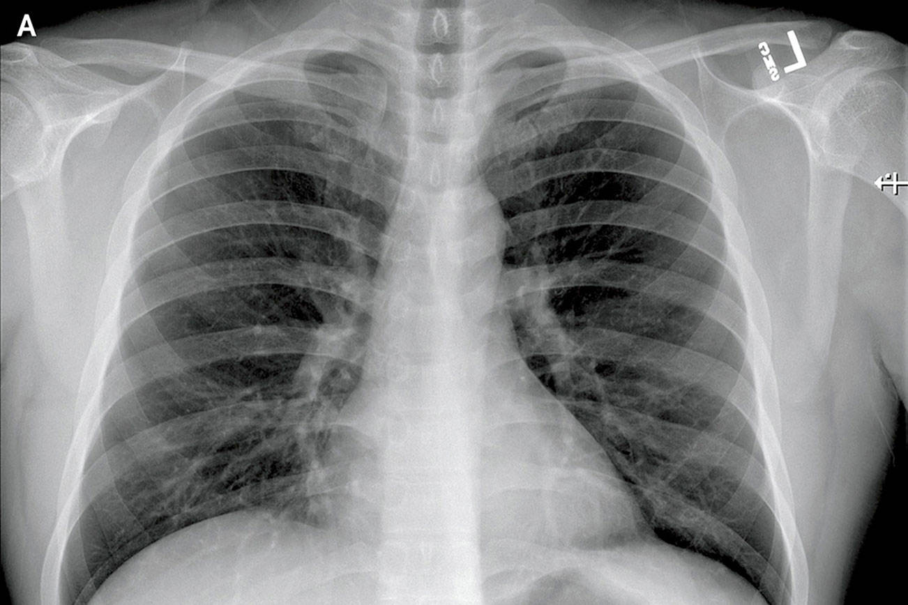 Posteroanterior and Lateral Chest Radiographs, January 19, 2020 (Illness Day 4).No thoracic abnormalities were noted (Snohomish Health District)